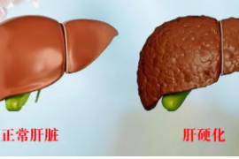 授課圖片—肝硬化圖片